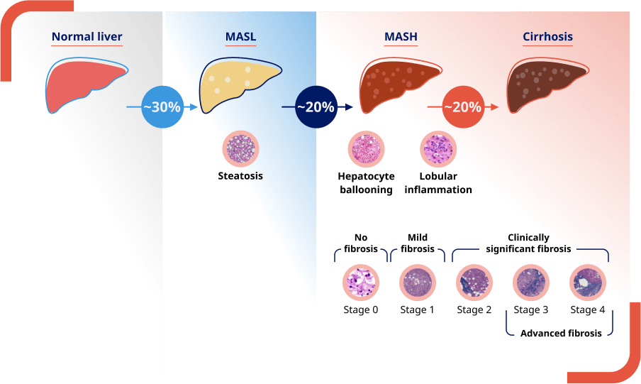 Spectrum of MASLD showing the progression of MASH in the liver